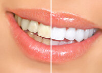 before and after results professional teeth whitening Tomball, TX